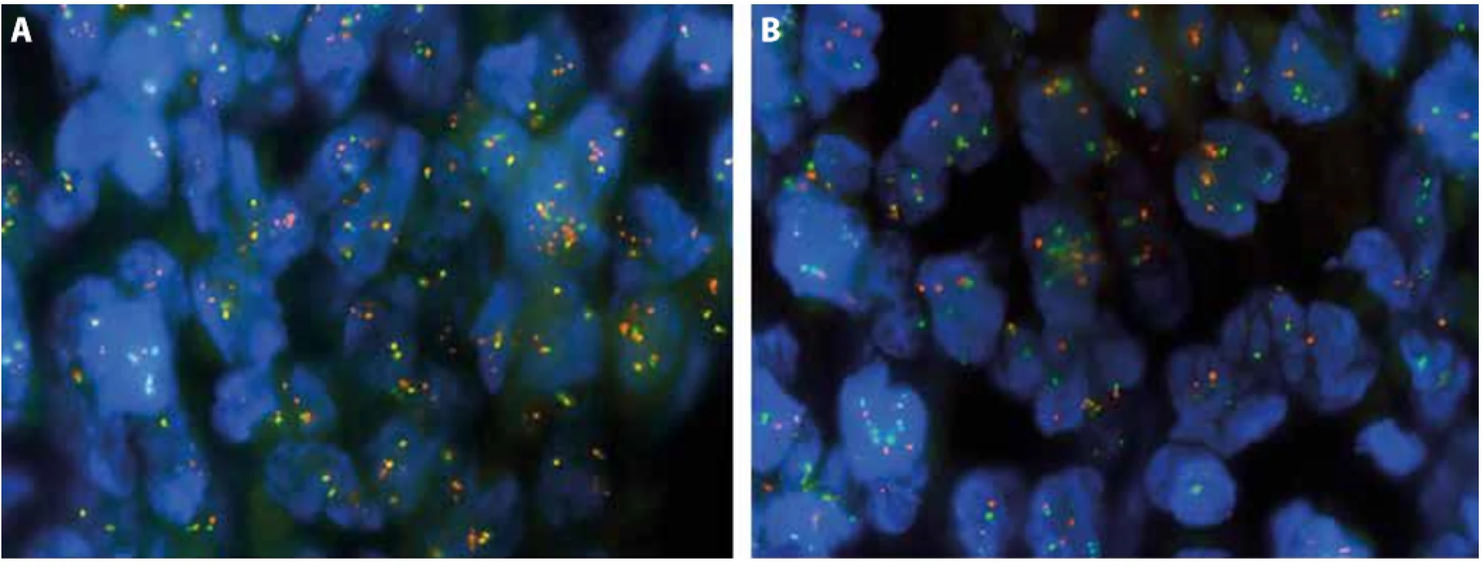 Foto z mikroskopické detekce translokace (17;22)(q22;q13) (COL1A1/PDGFB) v FFPE tkáni metodou fluorescenční in-situ hybridizace (FISH) s použitím specifické „break apart“ sondy PDGFB a fúzní COL1A1/PDGFB sondy. <br>A - PDGFB break apart sonda. Interfázní jádra obsahují žluté signály indikující intaktní kopii genu PDGFB, naopak oddělené oranžové signály ukazují nadpočetné kopie reranžovaného lokusu PDGFB. <br>B - COL1A1/PDGFB fúzní sonda. Interfázní jádra obsahují separované oranžové a zelené signály normálních lokusů COL1A1 a PDGFB, naopak fúzní oranžovo-žluto-zelené signály detekují COL1A1/PDGFB translokaci.