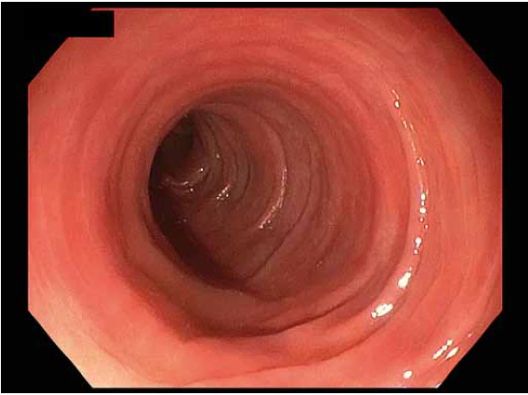 Kvalita střevní přípravy dle BBPS – hodnocení
3 body.<br>
Fig. 1. Quality of intestinal preparation according to BBPS –
3 points.<br>
BBPS – Boston Bowel Preparation Scale