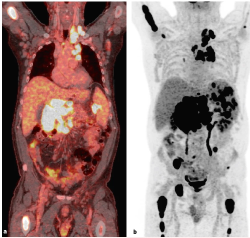 a, b Výsledek vyšetření PET/CT u pacienta s podezřením na Richterovu transformaci. Generalizovaná lymfadenopatie, postižení
sleziny a skeletu. Masivní lymfadenopatie zejména v retroperitoneu 11 × 6 ×13 cm s SUVmax 27. Provedená biopsie pod UZ kontrolou z levého
nadklíčku prokázala transformaci CLL do DLBCL. (Snímky poskytnuty laskavostí prim. MUDr. D. Zogaly, Ústav nukleární medicíny 1. LF UK
a VFN v Praze.)