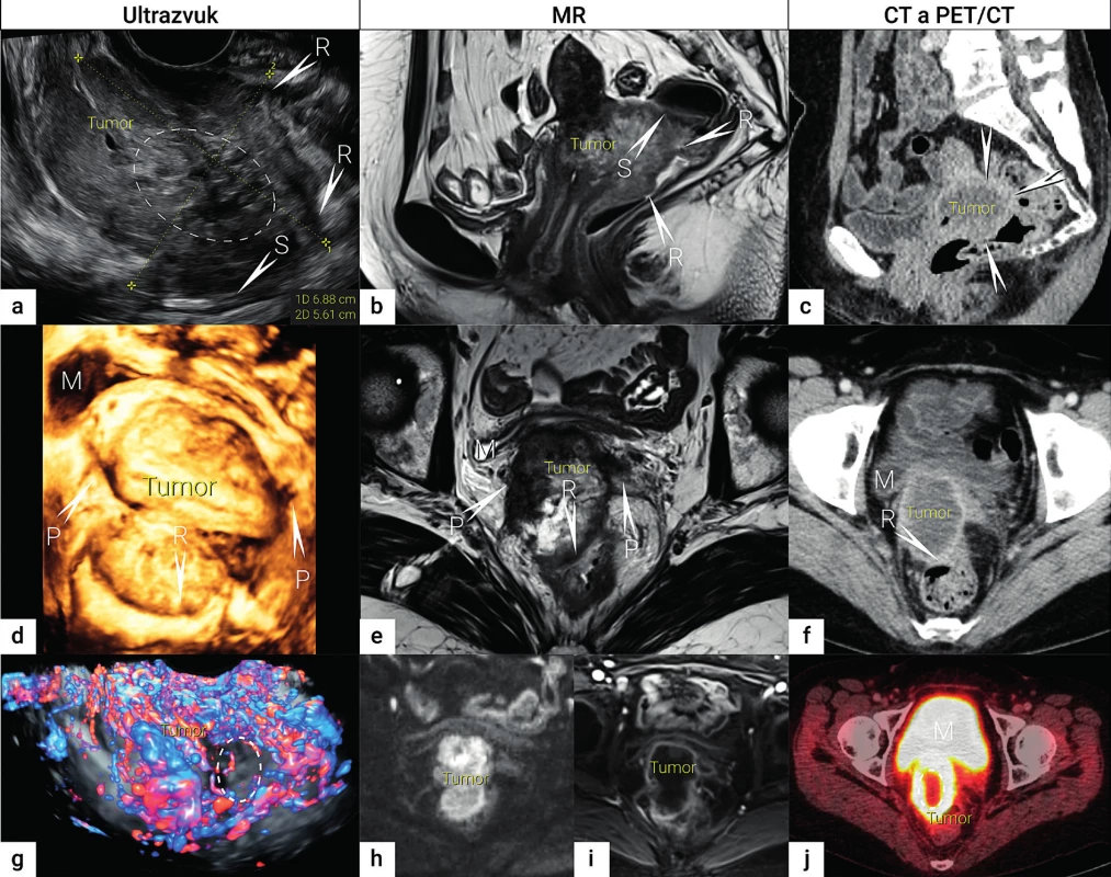 Zobrazení lokálního rozsahu nádoru<br>
Velký nekrotický tumor odpovídá přítomnosti lokálně pokročilého dlaždicobuněčního karcinomu s prorůstáním do rekta (R) a sigmoidea
(S), místo infiltrace označeno šipkou s písmenem postiženého orgánu. Nádor v sagitálním řezu zobrazen transrektálním ultrazvukem
(a), nekrotická porce nádoru označena elipsou, MR v T2 vážených obrazech (b) a CT (c). Nádor v transverzální rovině v transrektálním
ultrazvuku (d), MR v T2 vážených obrazech (e) a CT (f). Funkční zobrazení nádoru s využitím dopplerovského vyšetření (g), nekrotická
avaskulární porce nádoru označena elipsou, DWI (h), DCE (i) a FDG-PET/CT (j), kde opět nekrotická porce nádoru je označena elipsou.
MR – magnetická rezonance; CT – počítačová tomografie; PET/CT – pozitronová emisní tomografie fúzovaná s CT;
FDG – fluorodeoxyglukóza; DWI – diffusion weighted imaging, difuzně vážené obrazy; DCE-MRI – dynamic contrast enhanced MR imaging,
dynamické kontrastní MR zobrazení; M – močový měchýř; P – parametria; R – rektum; S – sigmoideum