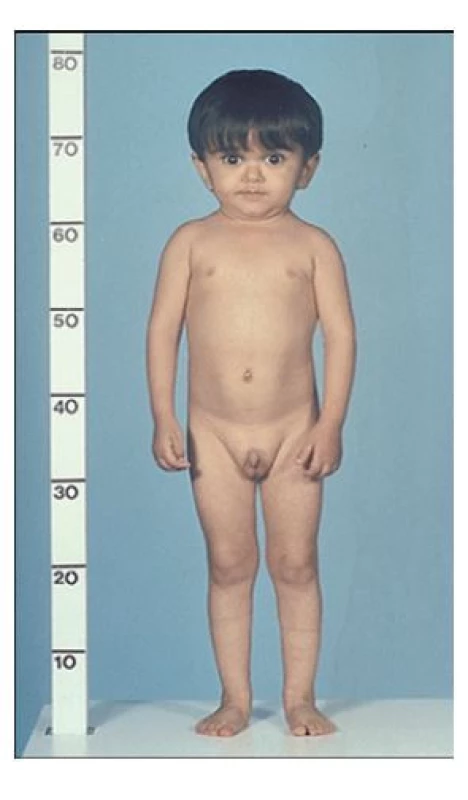 Fenotyp chlapce s necitlivostí
k růstovému hormonu
(Laronovým syndromem)
v důsledku patogenní
varianty GHR genu