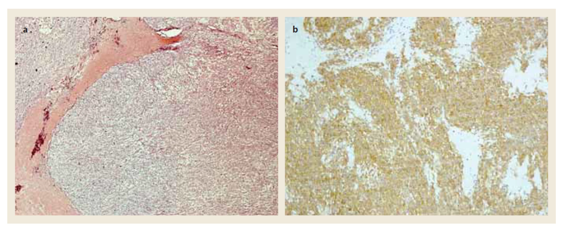 Mikroskopický preparát z tumoru žaludku: a) barvení hematoxylinen-eozinem; b) imunohistochemické vyšetření
exprese KIT proteinu (CD 117).<br>
Fig. 4. Histological preparation of gastric tumour: a) staining with hematoxylin-eosin; b) immunohistochemical investigation
of expression of KIT protein (CD 117).