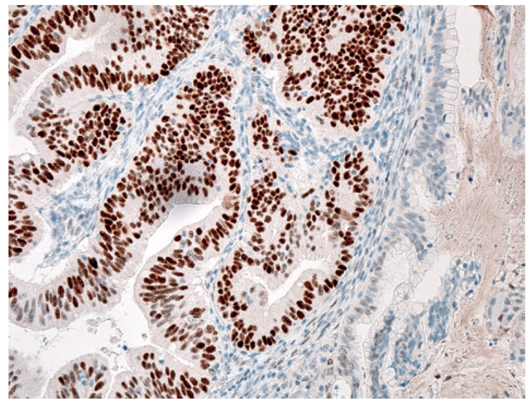 Imunohistochemie: silná difuzní jaderná exprese p53 v malignizované komponentě (vlevo), původní struktury cystade-nomu (vpravo) <br>
Fig. 6: Immunohistochemical examination: massive expression of nuclear p53 in malignant form (left), primary structure of cystadenoma (right)