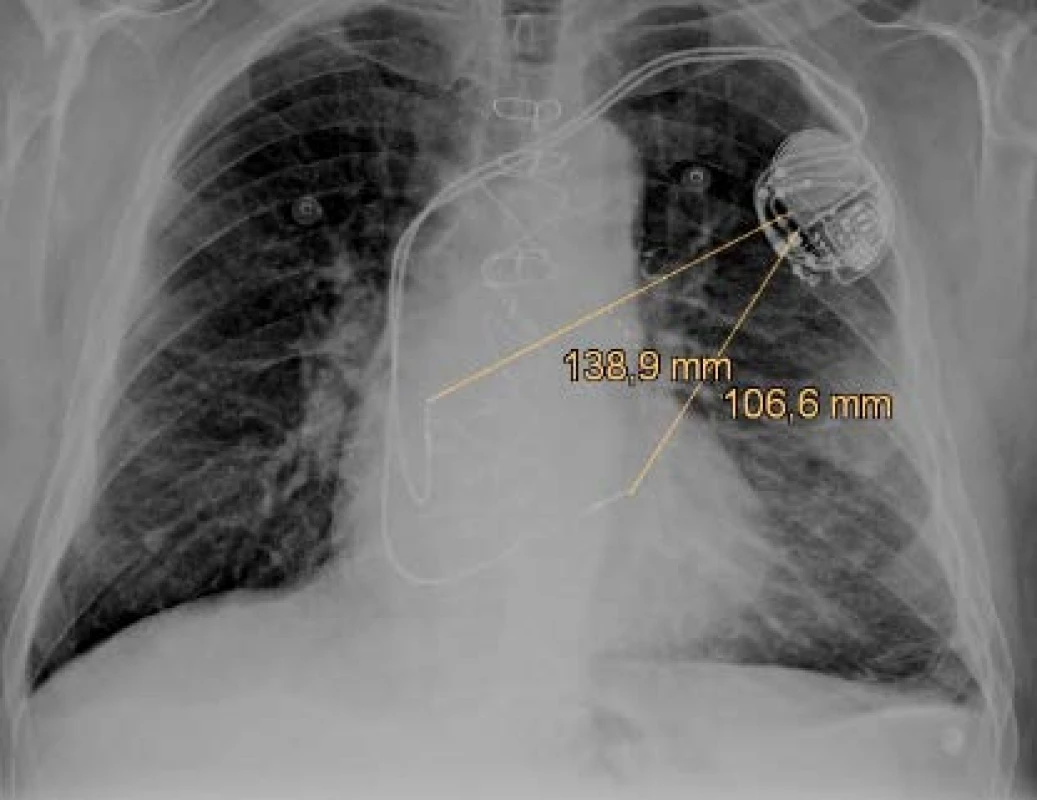 The anteroposterior x-ray projection of the dual
chamber pacemaker with figured pace/sense vectors.