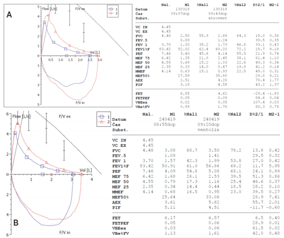 Průkaz parciální bronchiální reverzibility pomocí spirometrie průtok-objem u 15letého chlapce z těžké nezralosti:
A) standardizovaný bronchodilatační test – 4 vstřiky ipratropia á 20 μg, B) standardizovaný bronchodilatační test –
4 vstřiky salbutamolu á 100 μg).