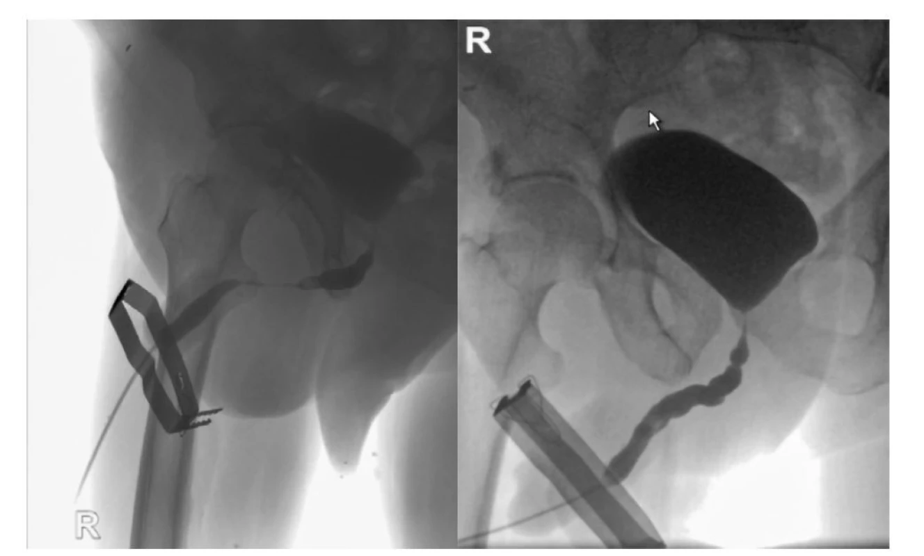Muž 67 let po laparoskopické nervy šetřící radikální prostatektomii pro adenokarcinom pT2c,N0 M0,
R0GS 7 (3+4) (4/2019). Již v 7/2019 byla patrná těžká striktura penilní uretry o délce 2 cm. Následně byla v 10/2019
zajištěna opakovaná retence moči a epicystostomie pro strikturu uretry. Uretroplastika byla dvakrát zrušena a po
výkonu (1/2021) má stresovou inkontinenci a používá 2 vložky denně (Tenna Men Level 1) (Qmax 12 ml/s, V 300 ml),
beze zbytku po močení.<br>
Fig. 3. Male 67 years old, after laparoscopic nerve-sparing radical prostatectomy for adenocarcinoma pT2c,N0
M0, R0GS 7 (3+4) (4/2019). Already in 7/2019, a severe stricture of the penile urethra with a length of 2 cm was
evident. Subsequently, repeated urine retention and epicystostomy for urethral striktura was provided in 10/2019.
Urethroplasty was twicetimes canceled and after procedure (1/2021) he has stress incontinence and uses 2 pads
per day (Tenna Men Level 1) (Qmax 12 ml/s, V 300 ml), without residue after urination.