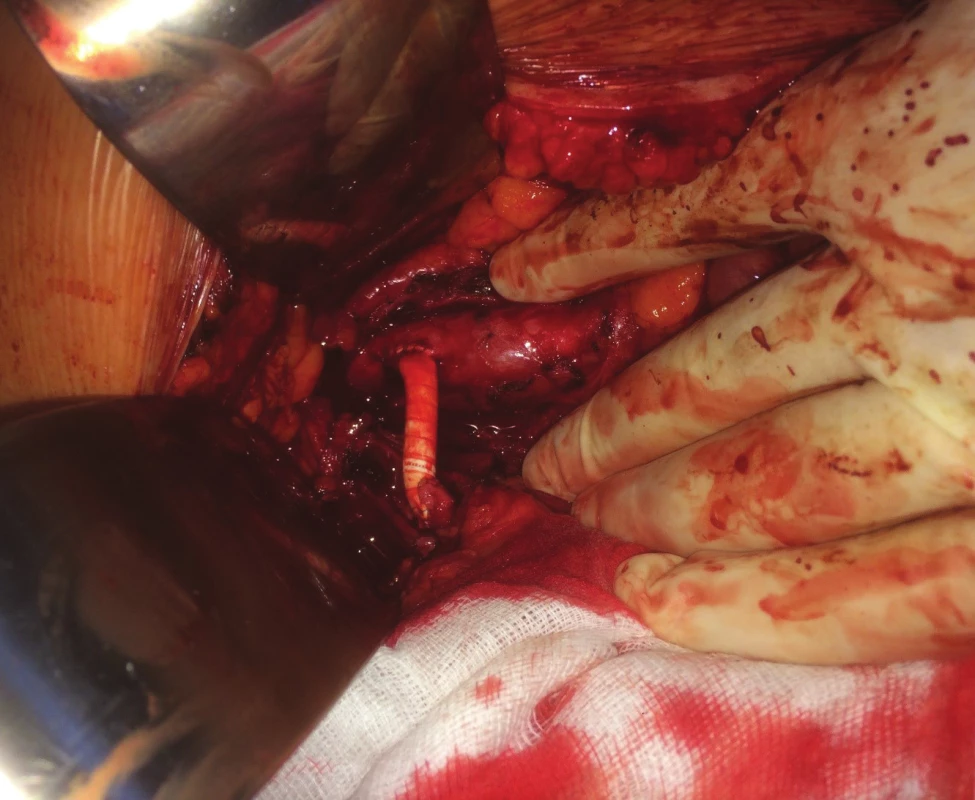 Retrográdní aorto-mezenterický protetický bypass<br>
Fig. 10: Retrograde aorto-mesenteric bypass (artificial
graft)
