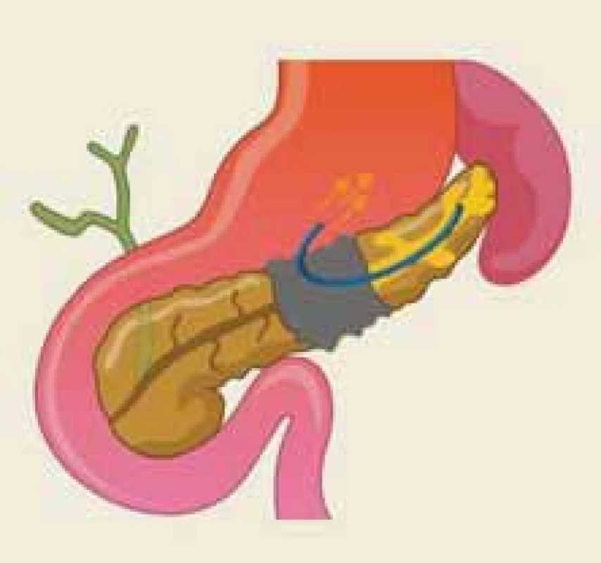 Endoskopicky založená pankreatikogastrostomie jako alternativní možnost léby syndromu odpojeného pankreatického vývodu u vybraných pacientů – ilustrace.<br>
Fig. 8. Endoscopic pancreaticogastrostomy as an alternative treatment for disconnected pancreatic duct syndrome in selected patients – an illustration.