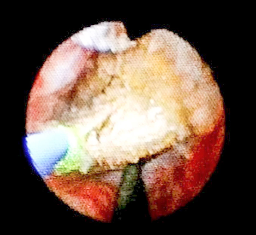 Peroperační foto – pohled ureteroskopem na
konkrement při trypsi v distálním ureteru (na č. 6 jistící
drát, na č. 8 laserové vlákno)<br>
Fig. 4. Peroperative photo – ureteroscopic view at the
stone in distal ureter during endoscopic trypsy (at six
o´clock guidewire, at eighl o´clock laser fiber)