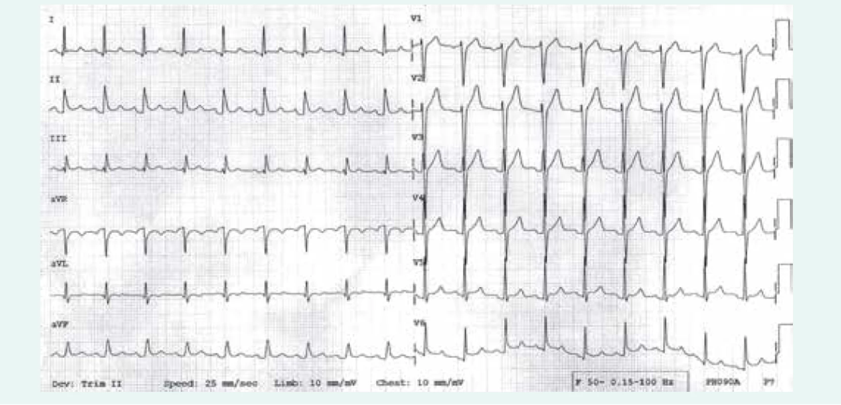 EKG nález u nemocného s akutní perikarditidou: patrny jsou difuzní, vzhůru konkávní elevace ST úseku,
doprovázené depresemi úseku PR (1. fáze EKG změn)