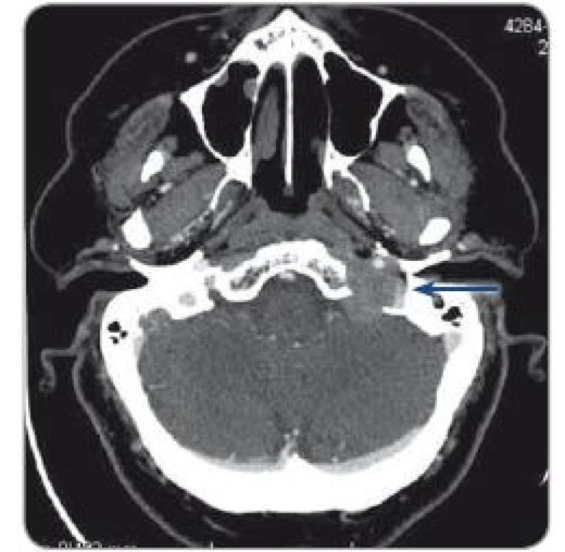 CT prior to surgery with a metastasis to scull base.