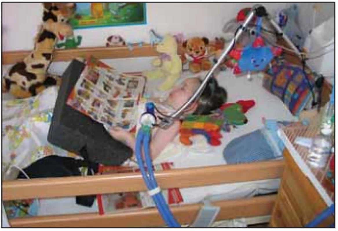 5letá dívka (SMA I), umělá plicní ventilace nutná
od 3 let věku.<br>
Fig. 3. A 5-year old girl (SMA I), ventilation necessary from 3 years
of age.