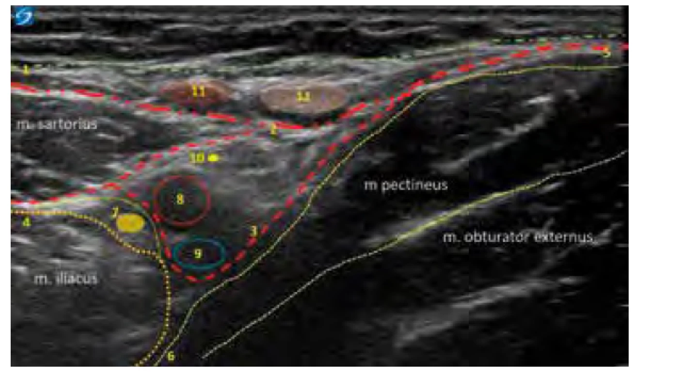 Ultrazvukový obraz přechodu iliopsoatické fascie do fascií svalů
předního kompartmentu. 1. povrchní fascie, 2. povrchní list fascia lata
(lamina cribrosa), 3. vnitřní list fascia lata, 4. iliopsoatický kompartment, 5. společná
fascia lata, 6. fascie m. pectineus, 7. nervus femoralis, 8. arterie femoralis,
9. vena femoralis, 10. femorální část n. genitofemoralis, 11. inguinální uzliny