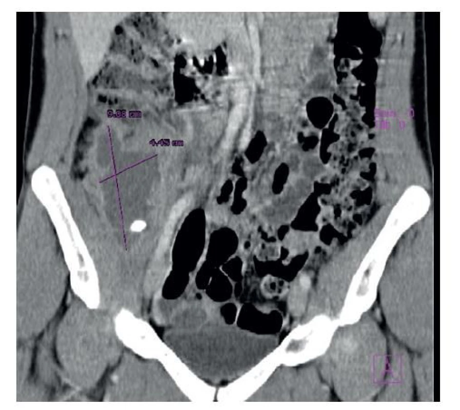 Kontrastné CT vyšetrenie (koronálna projekcia)
s nálezom hyperdenzného útvaru – apendikolitu v abscesovej
kolekcii<br>
Fig. 2: Contrast CT scan (coronal plane) with the finding of
a hyperdense formation – appendicolith in the area of the
abscess collection