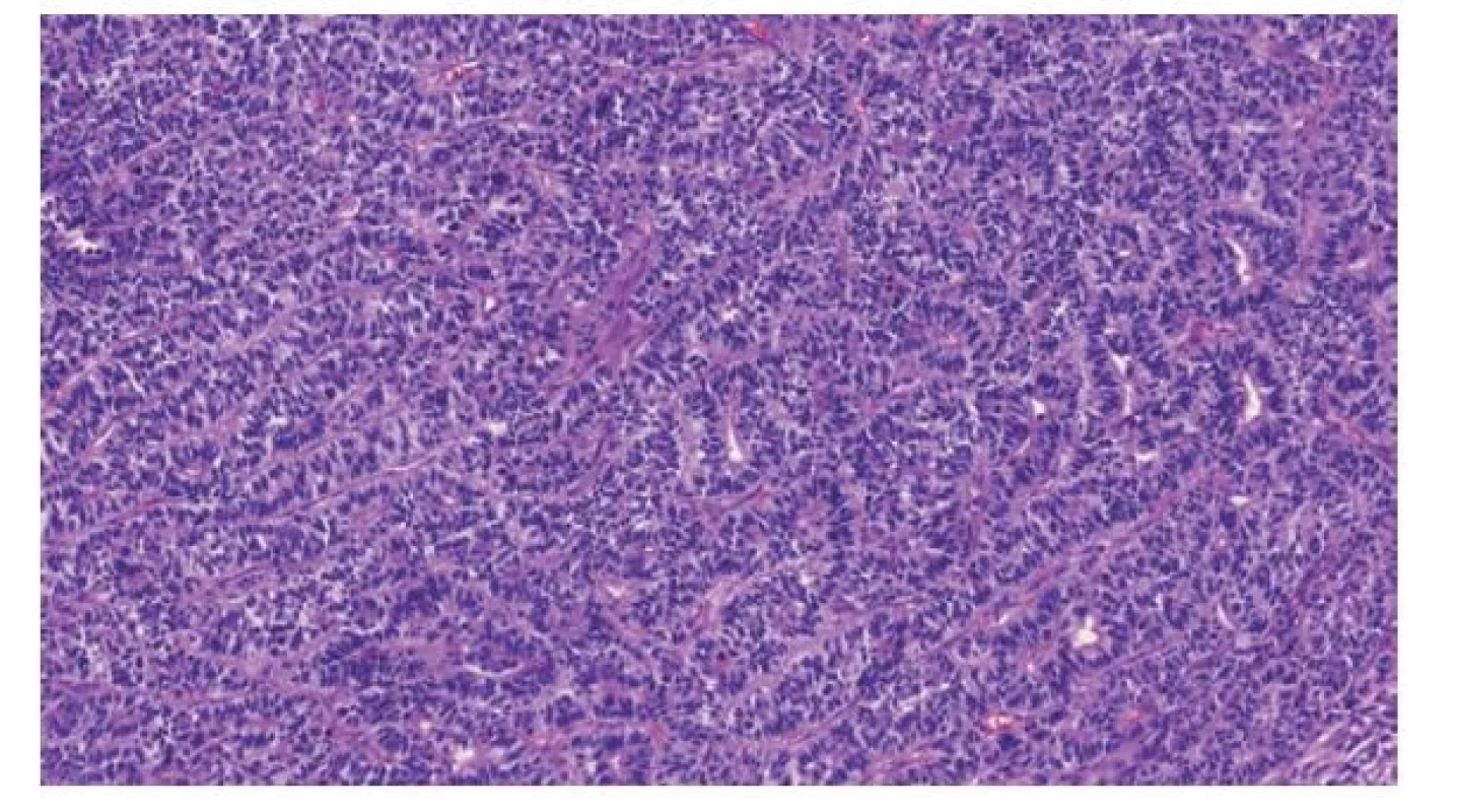 Charakteristickým histologickým obrazem neuroektodermálního
tumoru embryonálního typu (ENET) jsou tubulárně a rozetovitě uspořádané
primitivní neurální buňky s hyperchromními jádry a malým množstvím
cytoplazmy.