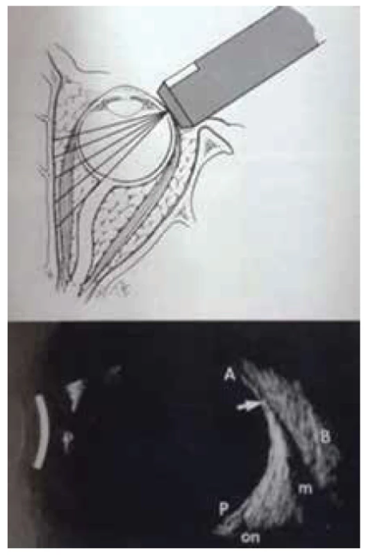 Longitudinal ultrasound image of
musculus rectus medialis