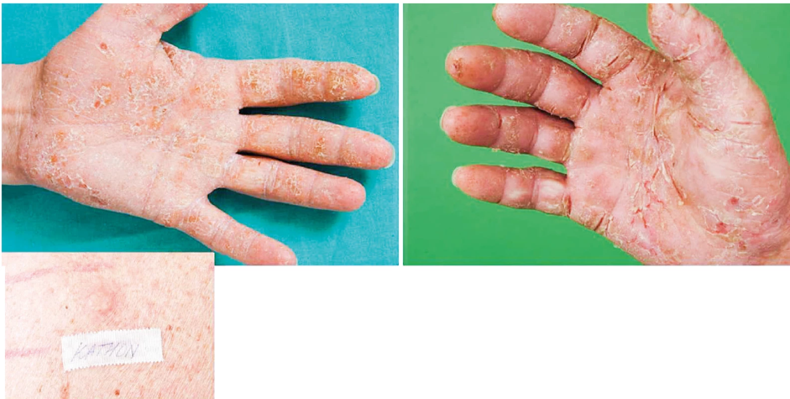 Eczema contactum prof. – KathonCG, izothiazolinové deriváty – atopická báze (chladicí
emulze)