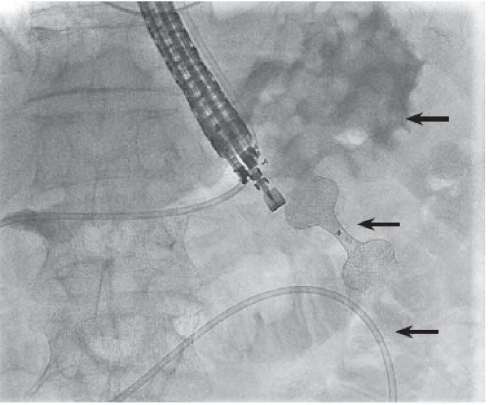 Skia obraz právě vytvořené gastroenteroanastomózy.
Horní šipka – tělo žaludku, prostřední šipka –
lumen apoziční metalický stent s ještě nerozvinutou středovou
částí, dolní šipka – jejunum se zavedeným irrigačním
katetrem.<br>
Fluoroscopic image of just formed gastroenteroanastomosis.
Upper arrow – stomach body, middle arrow –
lumen-apposing metal stent with still undilated central part,
lower arrow – jejunum with inserted irrigation catheter.