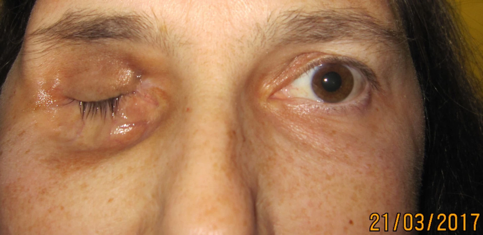 Patient in 3/2017 after systemic therapy, regression of tumor
findings in the orbit
