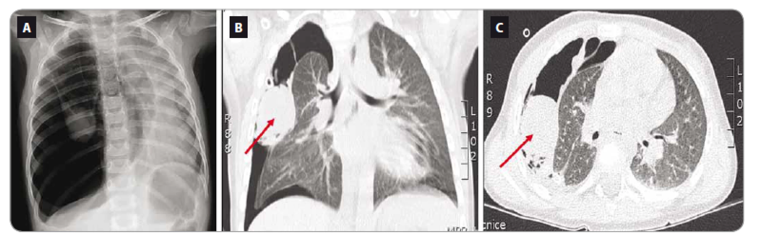 Vyšetření pacientky z kazuistiky 2. A. Rentgen hrudníku. B, C. Počítačová tomografi e plic – pleuropulmonální blastom v době
stanovení diagnózy.