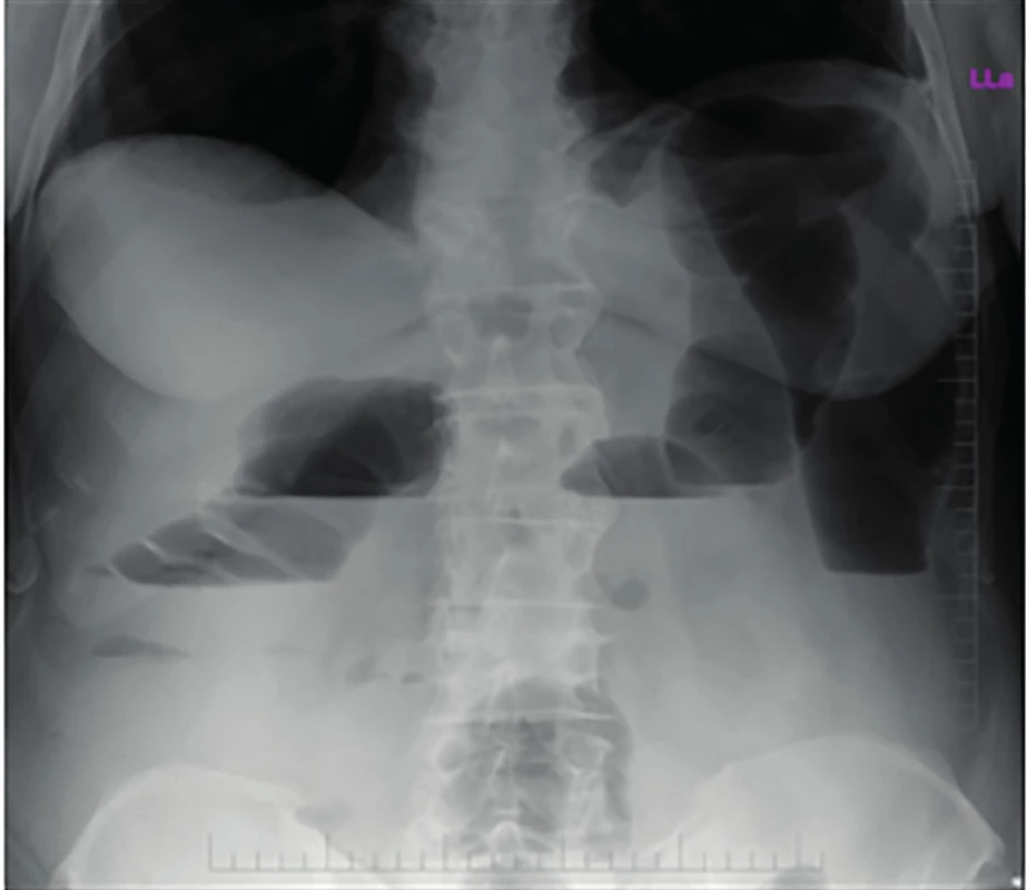 Natívna RTG snímka brucha v stoji s nálezom ileu
hrubého čreva<br>
Fig. 1: Native abdominal X-ray with finding of the large
bowel obstruction