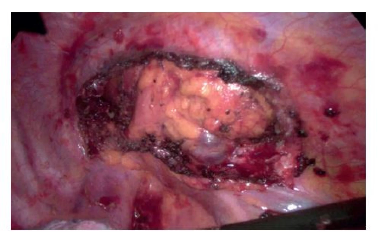 Výsledný stav po resekci prvního žebra<br>
Fig. 5: Exposure after removal of the first rib