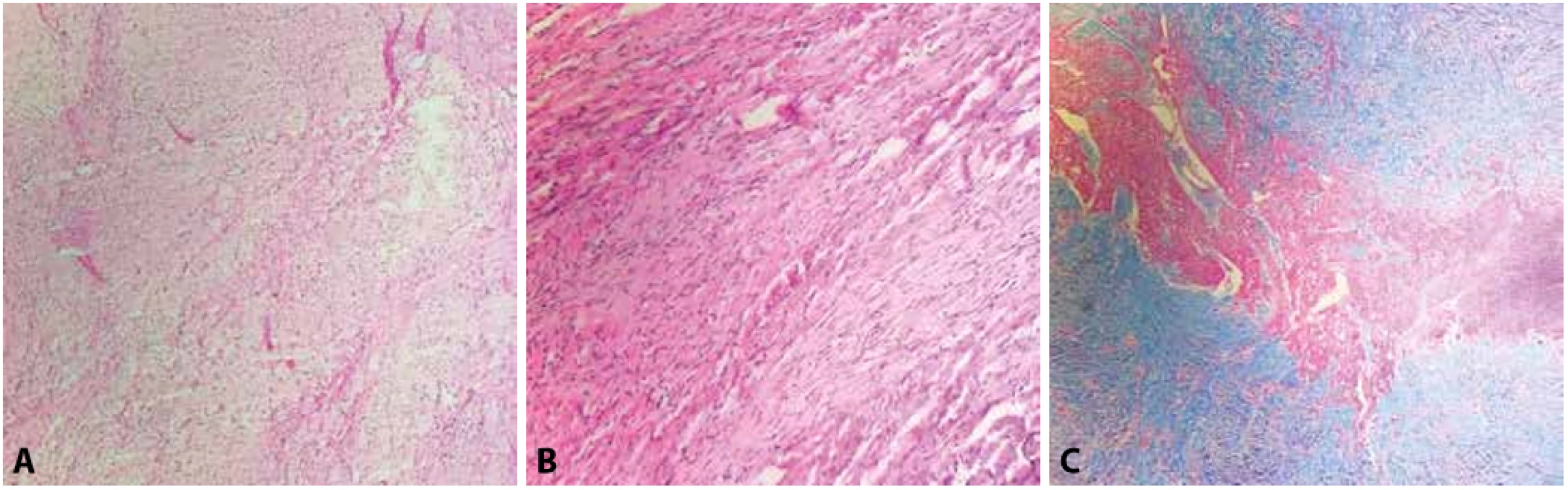  A, B: Srdeční fibrom tvořený fascikulárně rostoucími vřetenitými buňkami bez jaderných atypií a bez mitotické aktivity (hematoxylin & eosin, 100x, 200x). C: Okraj fibromu s patrným infiltrativním růstem do okolního myokardu (Massonův trichrom, 100x). 