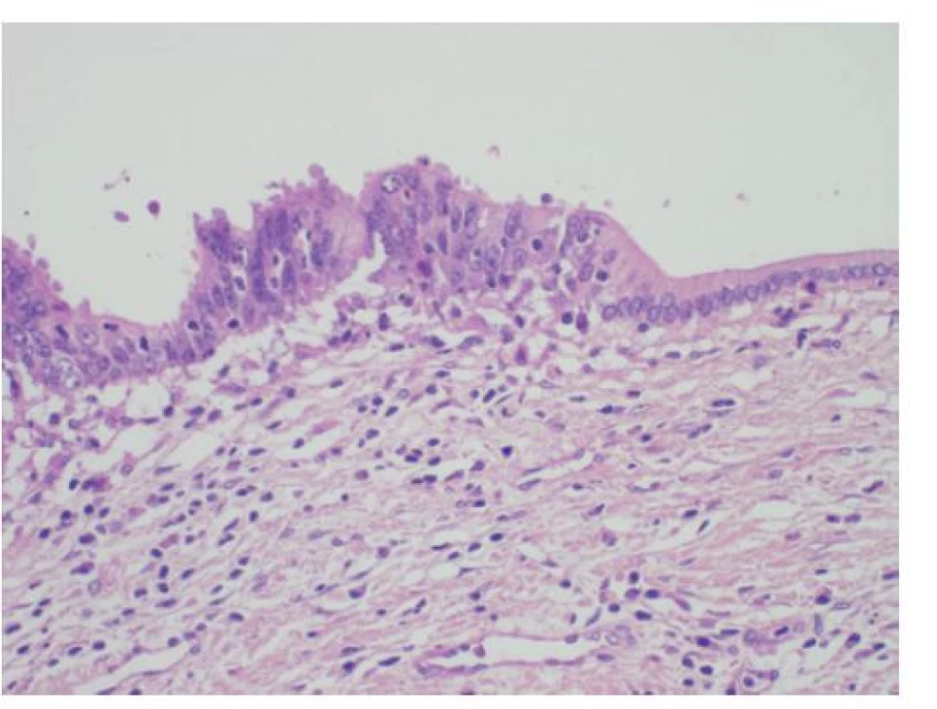 Histologie těžké dysplazie žlučovodu BiIN3 s pseudostratifikací,
ztrátou polarity epitelu a nápadnými jadernými
atypiemi (vlevo) na hranici s normálním biliárním
epitelem s bazálně situovanými monotónními jádry
(vpravo), HE, 400×<br>
Fig. 9: Histology of a high-grade bile duct dysplasia
(BiIN3) with pseudostratification, loss of epithelium polarity
and marked nuclear atypia (on the left); normal biliary
epithelium with monotonous basal situated nuclei (on
the right); HE, 400×