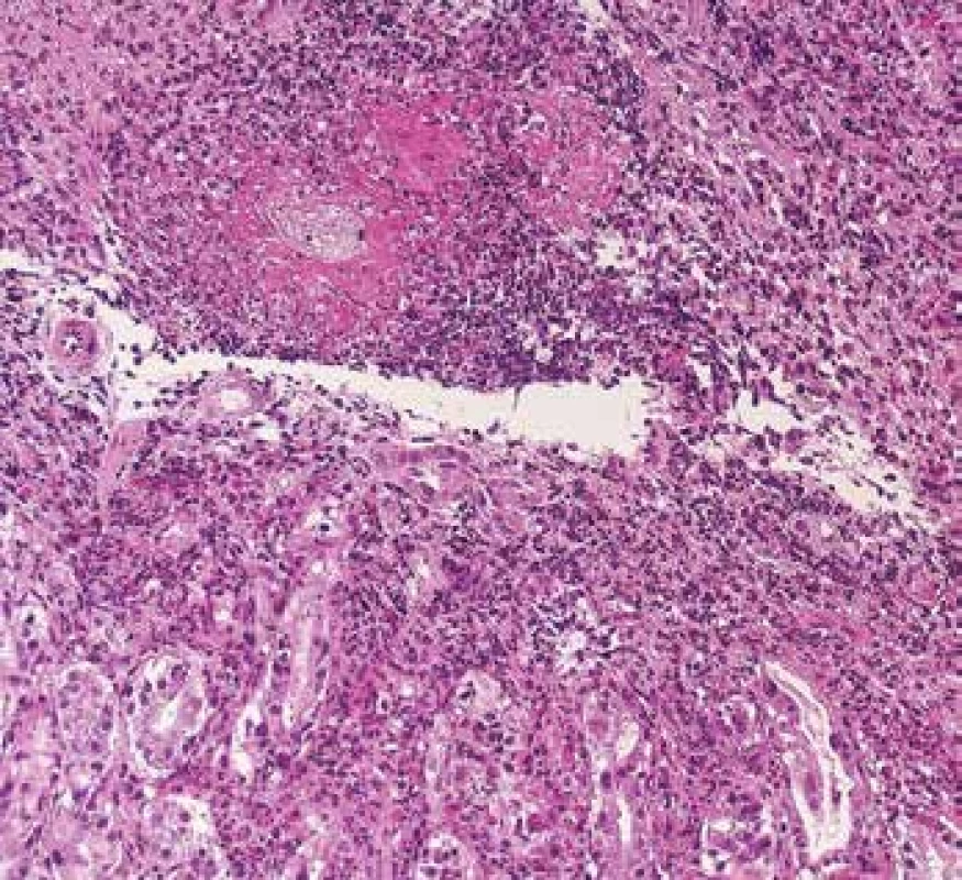 <b>Endoskopická biopsie žaludku s vaskulitidou</b> s cirkulární fibrinoidní nekrózou venul a s denzní zánětlivou celulizací v okolí (barvení HE).
