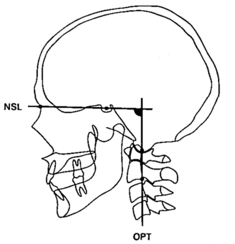 Fig. 2 Shows the position of the head to the cervical column; the craniocervical angle (NSL-OPT); taken from [34]
NSL: line from N (nasion) to S (sella);<br> OPT: inclination of the cervical column