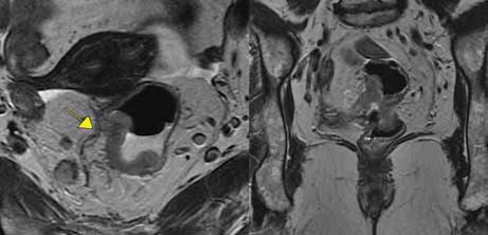 Tumor s extramurální vaskulární invazí+, vlevo transverzální rovina, vpravo
koronární rovina. 