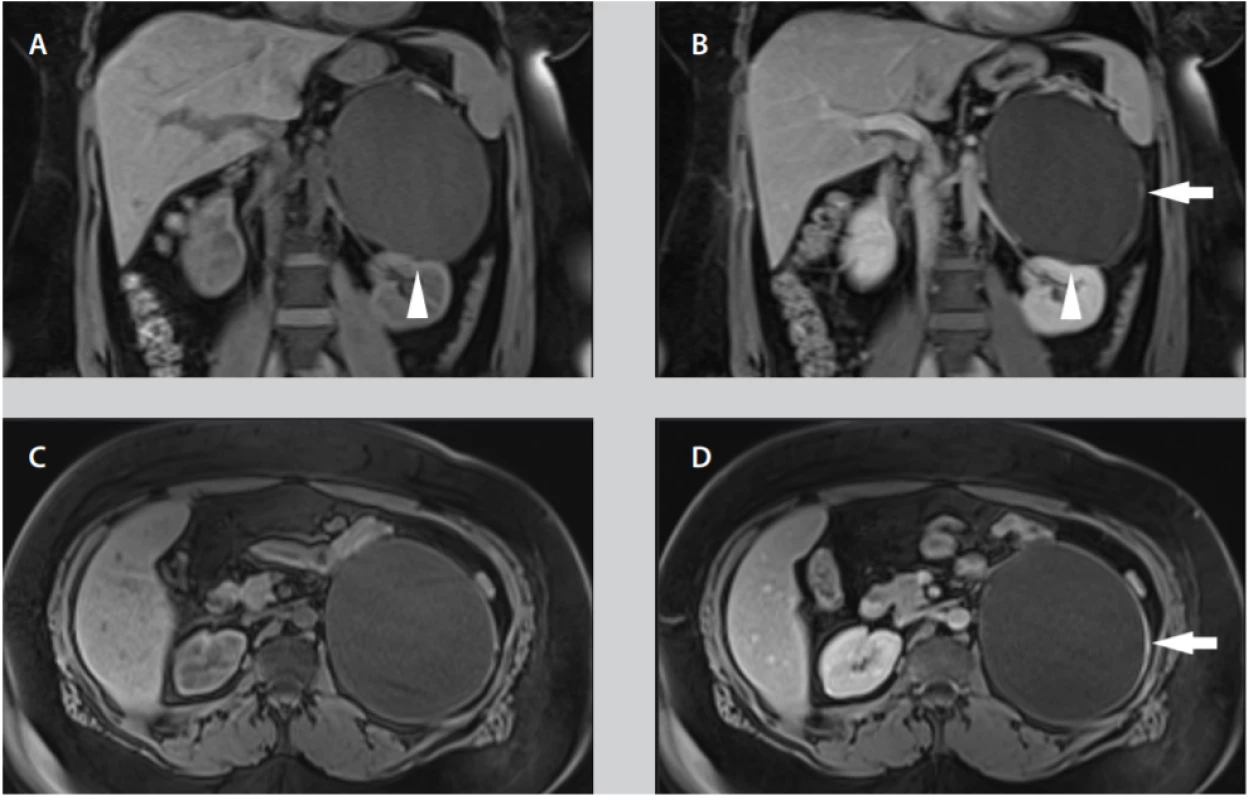 A–D. Při MRI vyšetření je patrný obraz objemné cystické léze v oblasti levé ledviny, dislokuje ji kaudálně. V místě naléhání na ledvinu je jemná nepravidelnost kontury (hlava šipky 1A, B) naznačující možný původ z ledviny. Po aplikaci kontrastní látky je patrné sycení mírně zesílené stěny (bílá šipka 1B, D); A – nativní T1 vážený obraz v koronální, B – postkontrastní T1 vážený obraz v koronální
rovině, C – nativní T1 vážený obraz v transverzální rovině, D – postkontrastní T1 vážený obraz v transverzální rovině.<br>
Fig. 1A–D. MRI examination reveals a large cystic lesion adjacent to the left kidney that dislocates it caudally. There
is a slight irregularity of the cyst contour at the kidney contact point (arrowhead 1A, B) indicating the origin from the
kidney. After the application of contrast agent, there is an enhancement of slightly thickened wall (white arrow 1B, D);
A – coronal unenhanced T1 weighted image, B – coronal contrast-enhanced T1 weighted image, C – axial unenhanced
T1 weighted image, D – axial contrast-enhanced T1 weighted image.