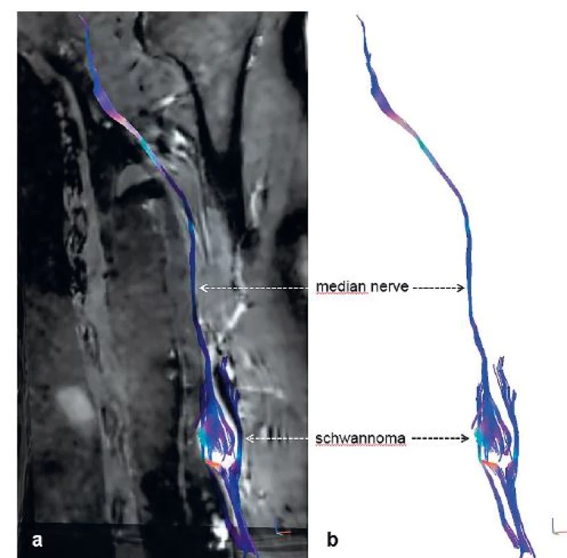 3D MR tractography (MRT) of schwannoma of the median nerve – (a) neural fascicle
projection into basic structural images of conventional MRI and (b) isolated MRT reconstruction