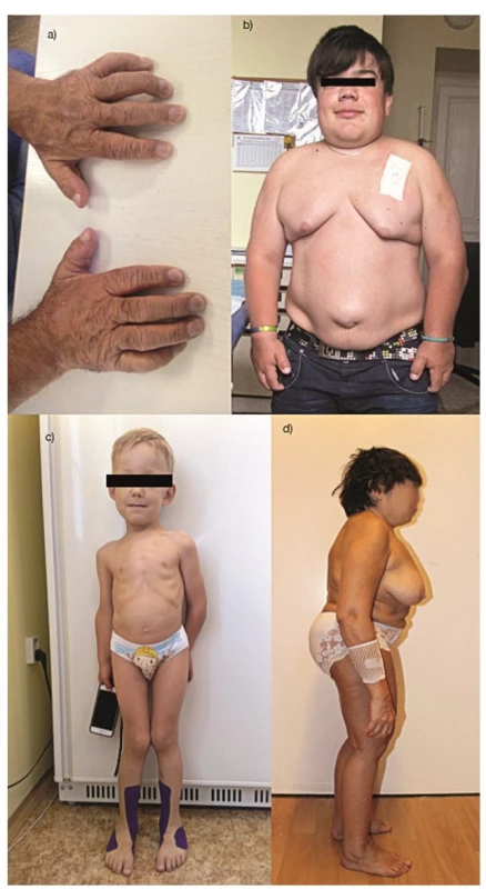 Klinické projevy pacientů s mukopolysacharidózou: a – drápovitá ruka, krátké a široké falangy u 50letého pacienta s mukopolysacharidózou
typu II, b – nízký vzrůst, kraniofaciální dysmorfie, kontraktury v loktech a malých kloubech ruky, soudkovitý hrudníku, pupeční
kýla u 18letého chlapce s mukopolysacharidózou typu II, c – krátká postava, genua valga, pectus carinatum u 4letého chlapce s mukopolysacharidózou
typu IVA, d – krátká disproporcionální postava, bederní lordóza, hrudní kyfóza u 60leté pacientky s mukopolysacharidózou
typu IVB