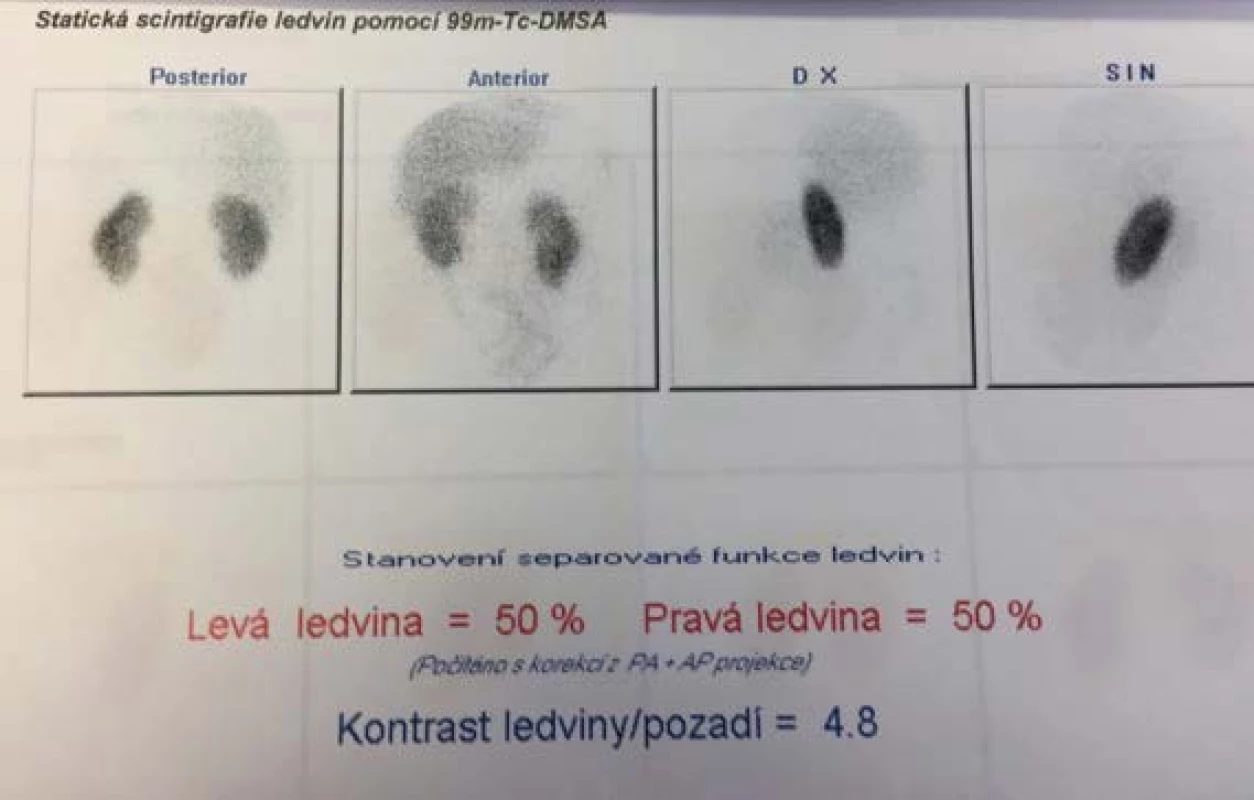 Statická scintigrafie (DMSA) před indikací
operační léčby (archiv autora)<br>
Fig. 2. DMSA scan before operation