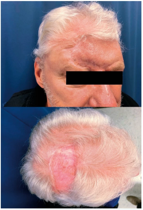 Status 6 months post-operative