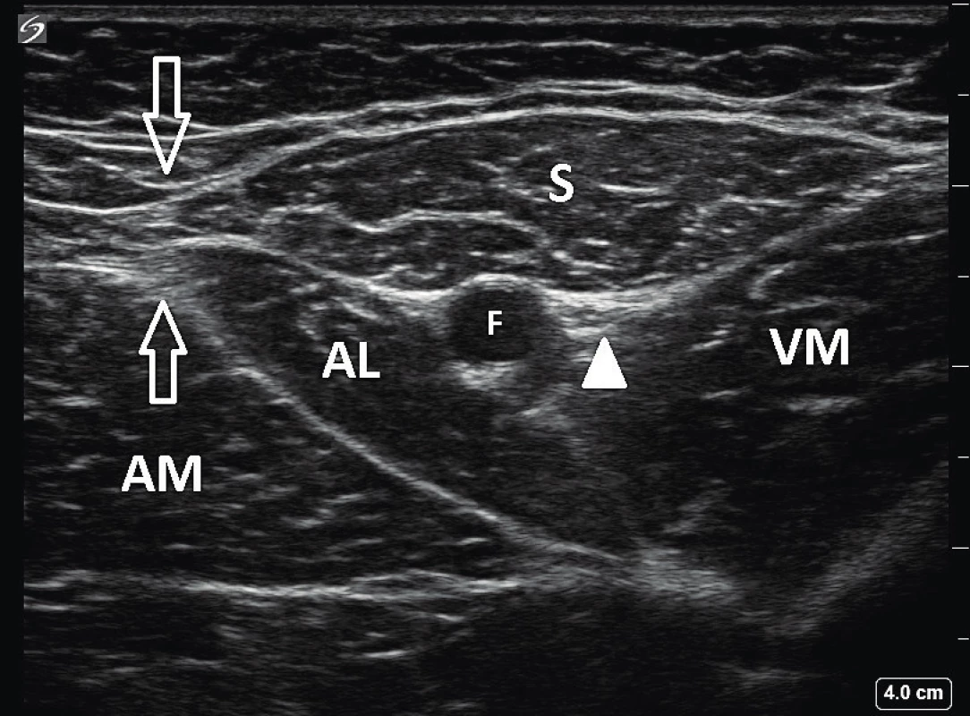 Ultrazvukový obraz stehna LDK v úrovni apexu
femorálního trojúhelníku: S – m. sartorius, AL – m. adductor
longus, AM – m. adductor magnus, VM – m. vastus medialis,
F – femorální tepna, prázdné šipky ukazují překrytí mediálních
okrajů m. sartorius a m. adductor longus – apex FT, bílý
trojúhelník označuje interfasciální prostor, ve kterém je nervus
saphenus