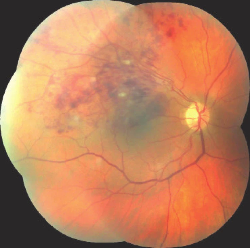 Retina of right eye in patient with occlusion of superior temporal branch of central
retinal vein – image obtained upon indication of intravitreal treatment with ranibizumab, on
the retina there is a finding of spattered haemorrhages and cotton wool spots in the central
region and in the upper temporal quadrant of the retina, best corrected visual acuity in the
right eye at the time of indication is 6/30