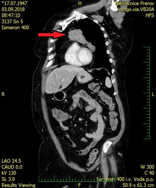  CT vyšetření hrudníku a břicha s kontrastní látkou, sagitální řez, tumor
předního mediastina – šipka
