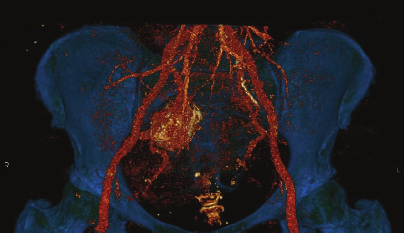 CT AG − Aneuryzma na vnitřní pánevní tepně vpravo<br>
Fig. 1: CT AG – Right hypogastric artery aneurysm