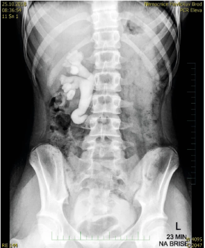 Vylučovací urografie – 23. minuta vyšetření po podání kontrastní látky – dilatace dutého systému pravé ledviny a proximální části močovodu končící u obratle L3.<br>
Intravenous urography. Renal pelvis and the proximal part of ureter dilatation ending by 3rd lumbal vertebra in 23rd minute of the study.