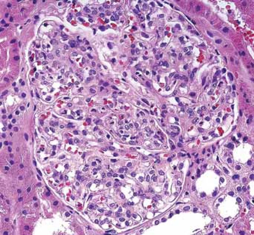 Histologické nálezy u pacientů s IBD a renálním postižením (tubulointersticiální nefritida, glomerulonefritida, AA amyloidóza).<br>
Fig.5. Biopsy pictures in IBD patients with renal illness (tubulointerstitial nephritis, glomerulonephritis, AA amyloidosis).