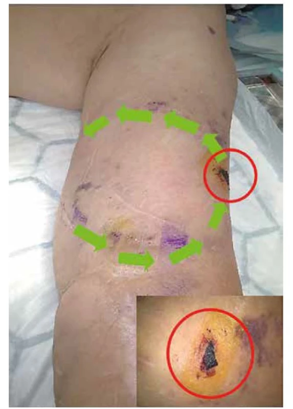 Průběh protézy AVG a defekt<br>
Fig. 4: AVG – prothesis and defect locations