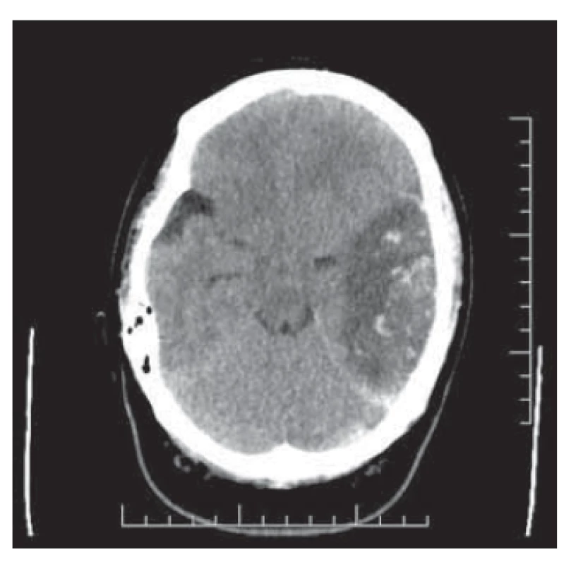 Trombóza splavů s hemoragickou
malácií temporálně vlevo a výrazným
mass-efektem.<br>
Fig. 1. Raft thrombosis with hemorrhagic
pain temporally to the left and
a marked mass effect.