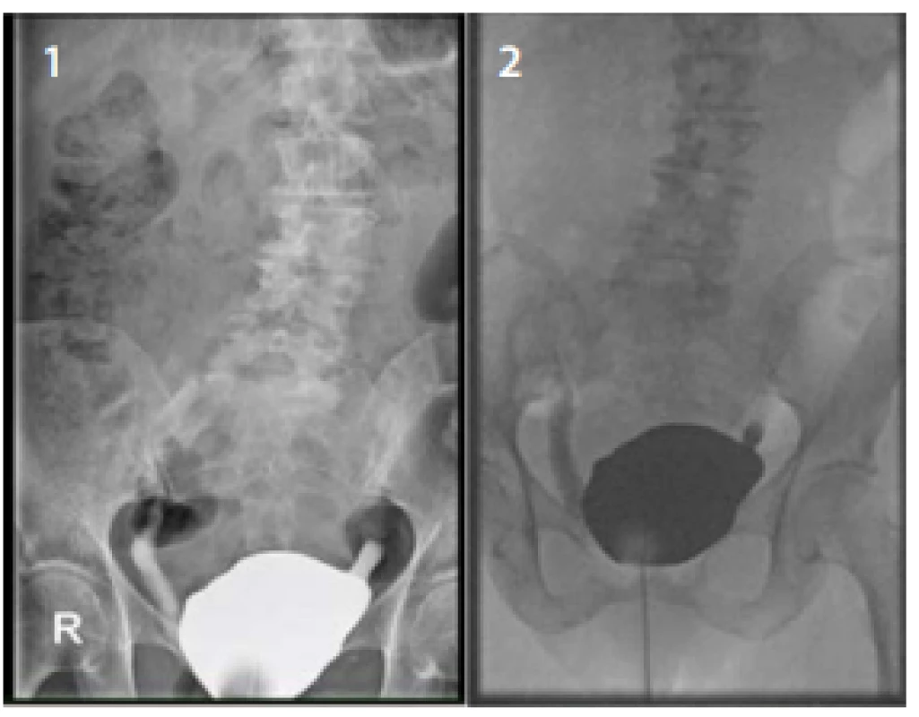 a 2. Předoperační cystografie zobrazující oboustranný
pasivní vezikoureterální reflux při náplni 100 ml<br>
Fig. 1. and 2. Preoperative cystography showing
bilateral passive vesicoureteral reflux with a bladder
volume of 100 mL