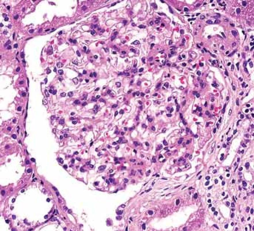 Histologické nálezy u pacientů s IBD a renálním postižením (tubulointersticiální nefritida, glomerulonefritida, AA amyloidóza).<br>
Fig. 4. Biopsy pictures in IBD patients with renal illness
(tubulointerstitial nephritis, glomerulonephritis,
AA amyloidosis).