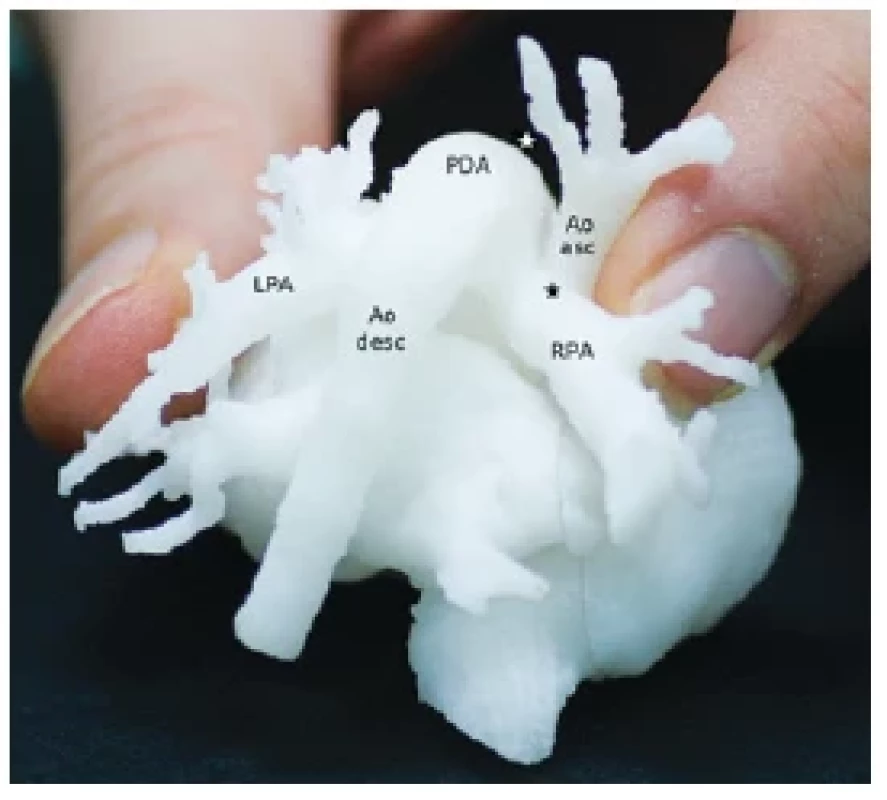 3D tlačený model srdca a veľkých ciev. Pohľad zozadu. Novorodenecké
srdce pacienta s interupciou aortálneho oblúka typu
A a aortopulmonálnym oknom typu II (spojenie Ao asc a RPA ).
Výhodou využitia tlačených 3D-modelov je možnosť presného
hodnotenia patologickej anatómie srdca a veľkých ciev vytlačených
v reálnej veľkosti priamo v rukách kardiochirurga a kardiológa
s cieľom naplánovania optimálnej intervencie. V uvedenom prípade
bol na základe analýzy 3D modelu zvolený nasledujúci kardiochirurgický
zákrok: preťatie širokého PDA, spojenie proximálneho
pahýľu ascendentnej aorty s descendentnou aortou, oddelenie
ascendentnej aorty od RPA .