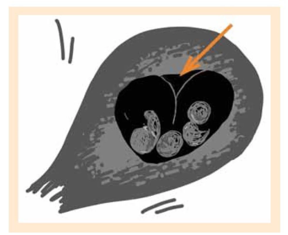 a. Black lambda sign, schematické znázornění ultrazvukového
nálezu (autor: Osičková V).<br>
Fig. 4a. Black lambda sign, schematic representation of an
ultrasound finding (author: Osičková V).