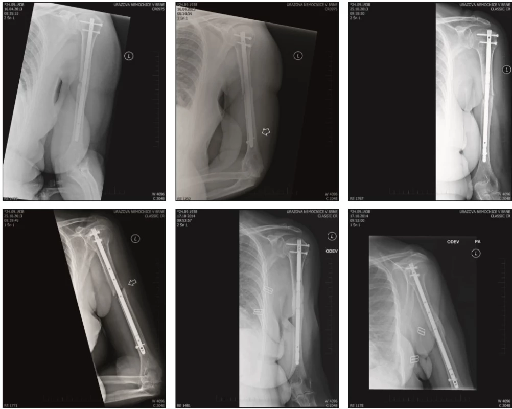 RTG humeru v anteroposteriorní a bočné projekci pooperační (3a), v odstupu devítí (3b) a 18 měsíců (3c). Na zobrazených RTG je zachycena osteosyntéza hřebem s distálním jištěním jedním šroubem. V odstupu devíti měsíců od operace není patrná progrese hojení zlomeniny.  Provedená dekortikace a spongioplastika vedla ke zhojení zlomeniny 18 měsíců od úrazu (3c)