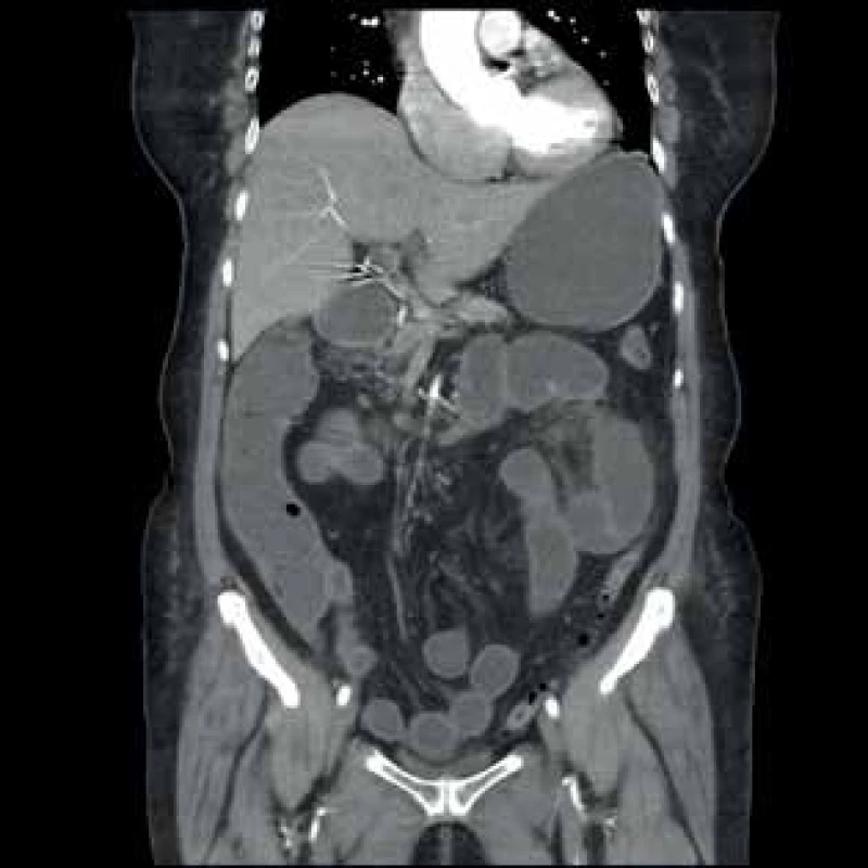 CT vyšetření − dilatace kliček tenkého střeva, pokročilé
aterosklerotické změny AMS s omezeným průtokem<br>
Fig. 1: CT image − small intestine dilatation, advanced
atherosclerotic changes of AMS with reduced flow